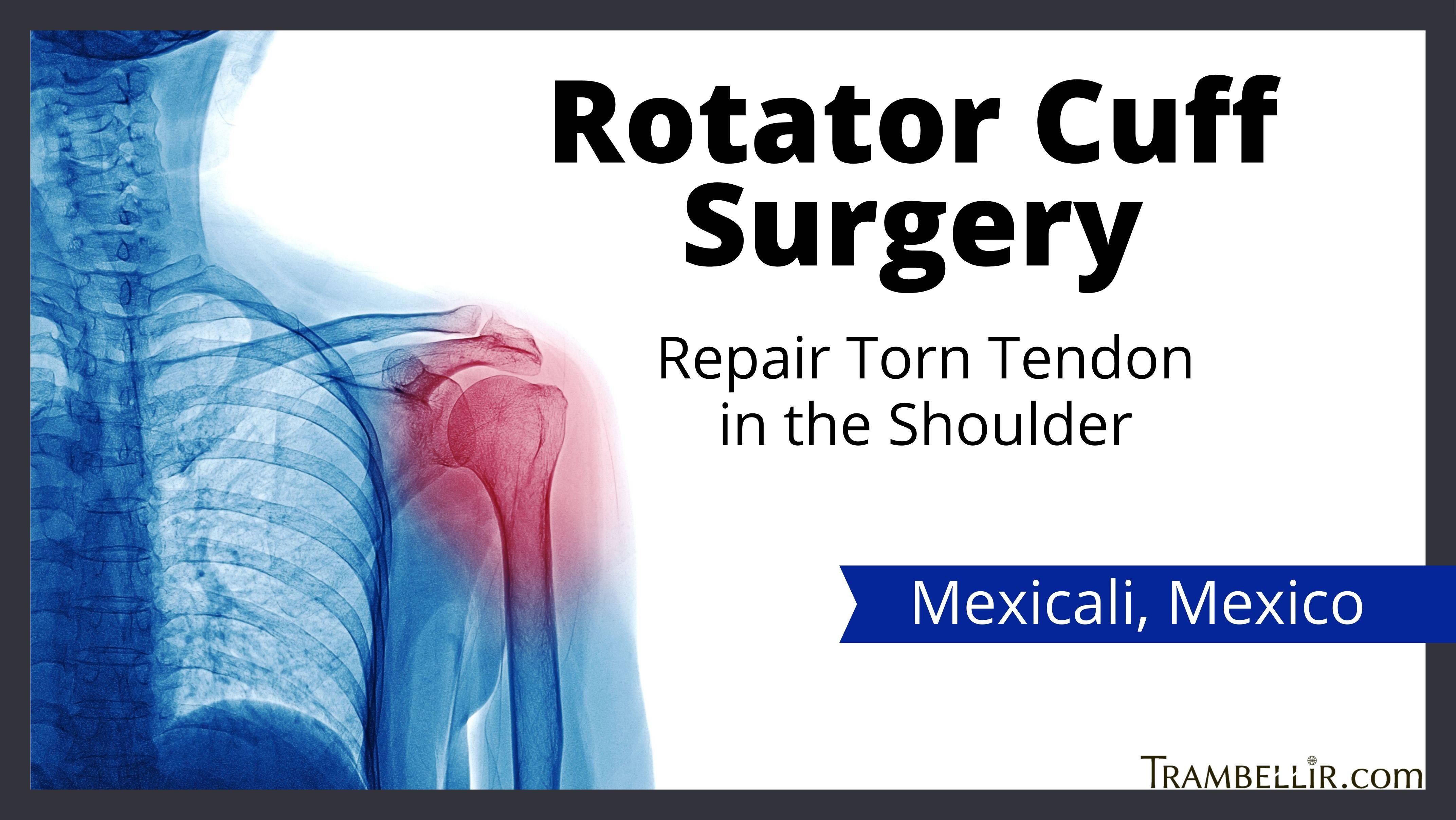 Rotator Cuff Replacement Surgery