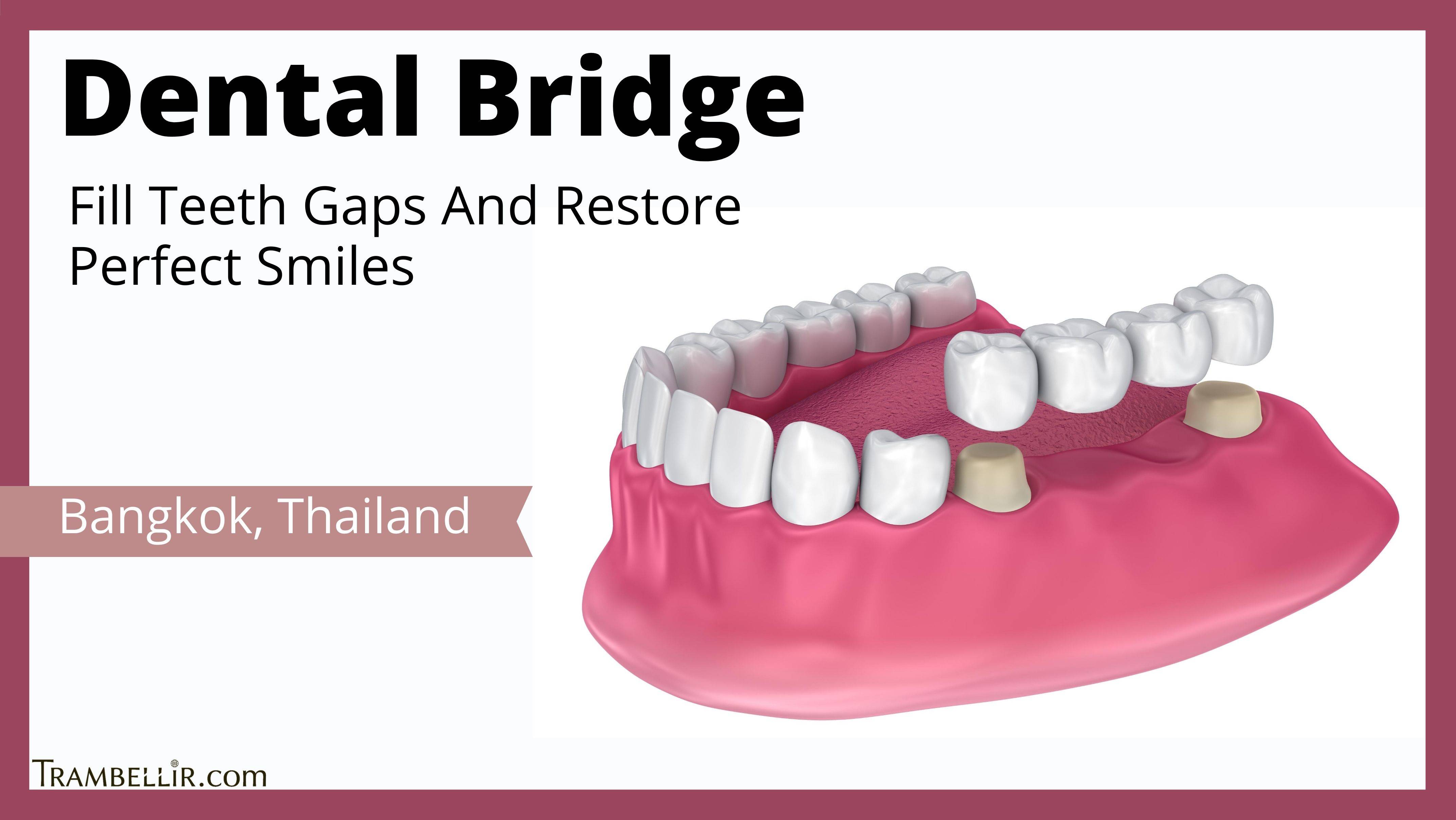 Dental Bridge (Fill Teeth Gaps And Restore Perfect Smiles) Trambellir