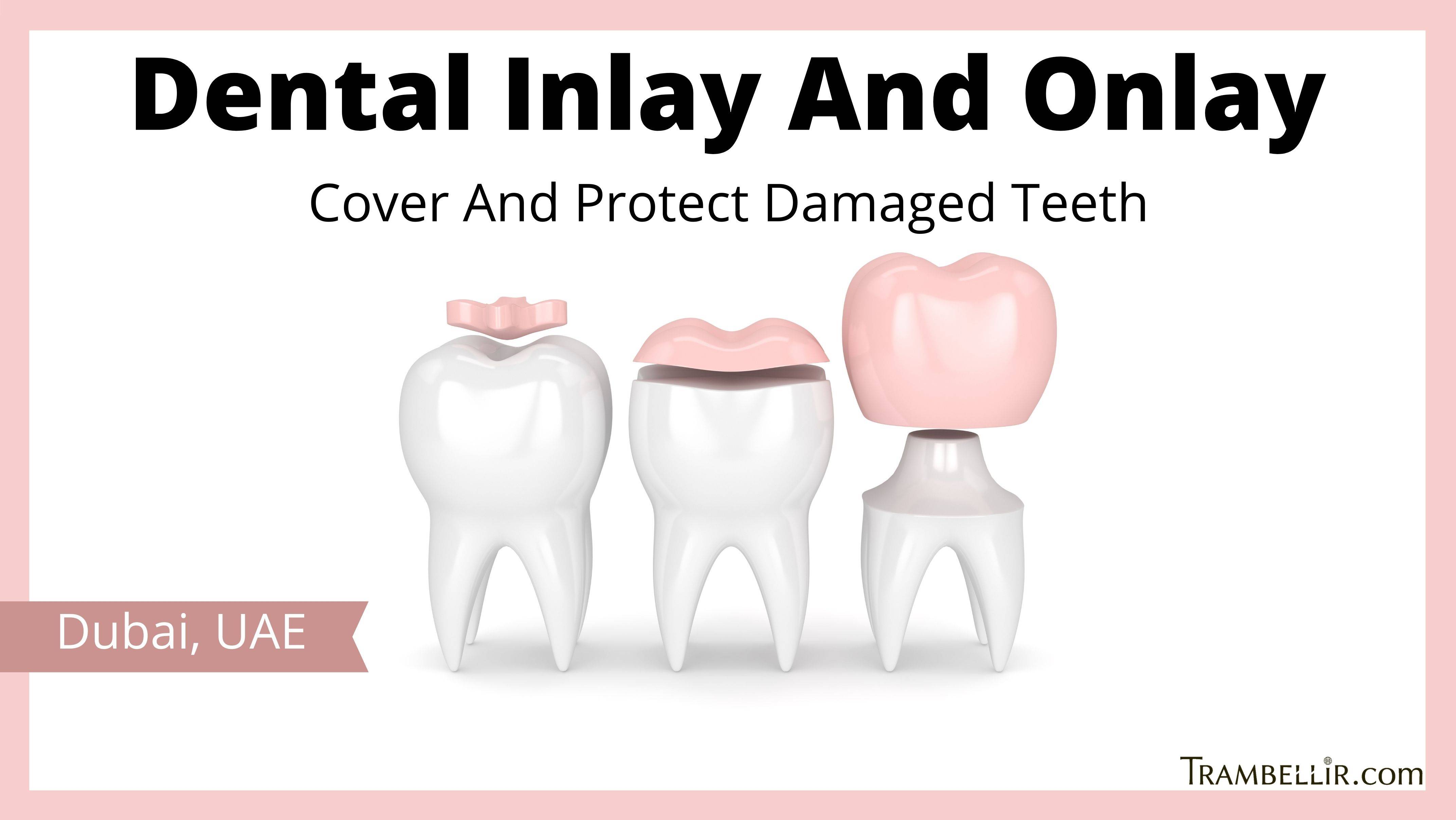 Dental Inlay And Onlay (Cover And Protect Damaged Teeth) Trambellir